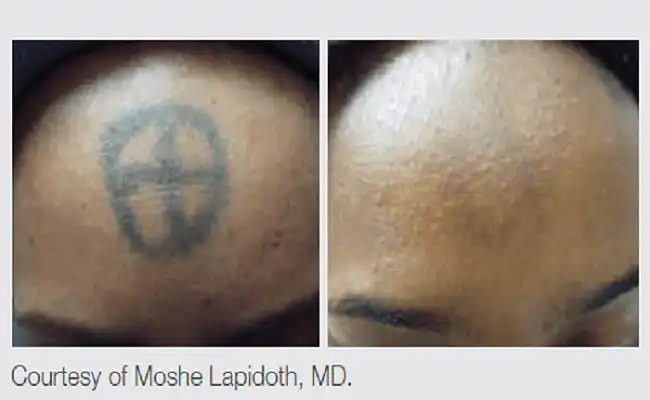 Tattoo removal